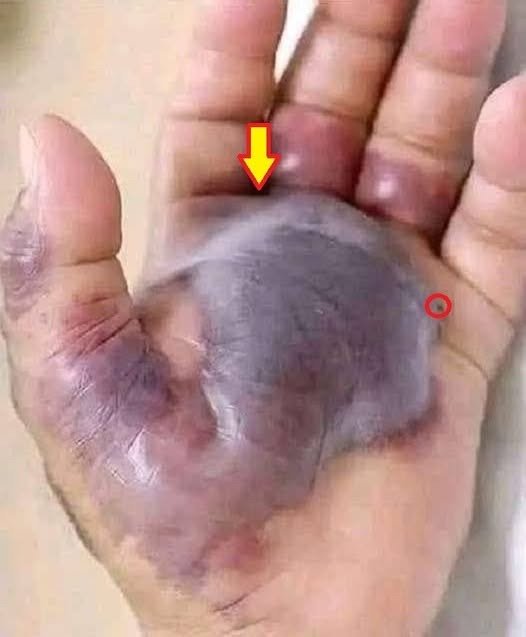 Doctors Issue Urgent Warning After Small Bite Turns Hand Black: The Signs You Must Not Ignore