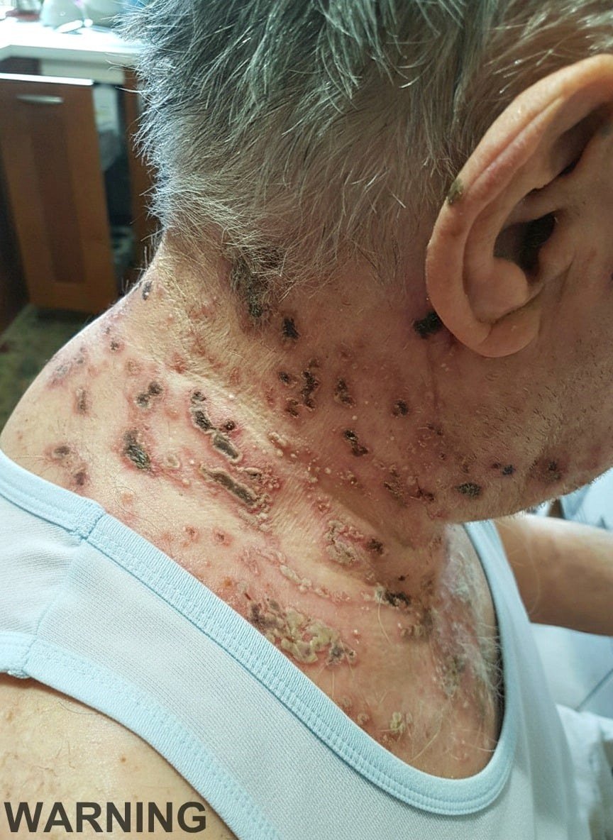 The Sleeping Monster Inside Your Nerves: Why Millions Are at Risk for an Excruciating Viral Attack